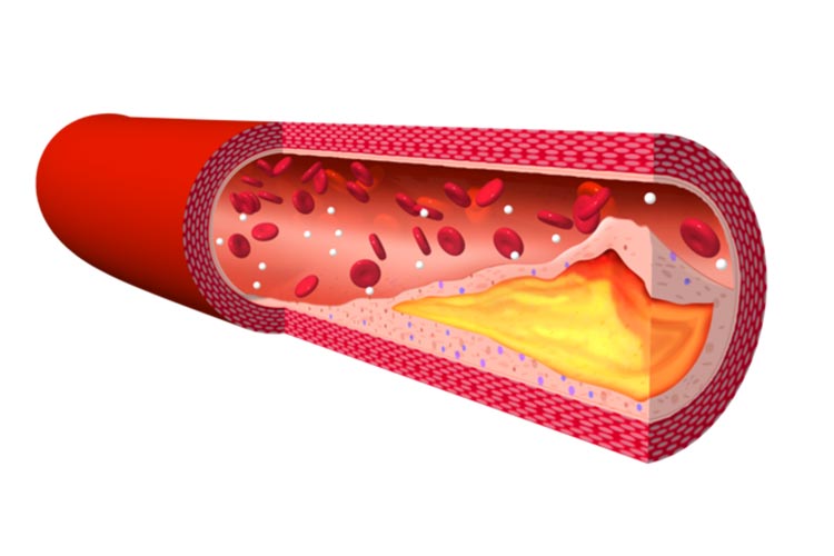 動脈硬化のイメージ